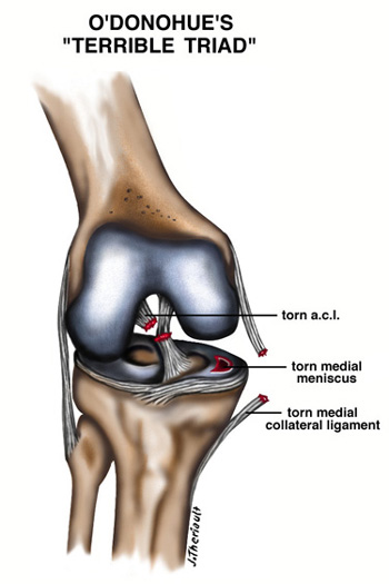 Diagram of O'Donohue's Terrible Triad Showing a Torn ACL, Torn MCL and Torn Medial Meniscus