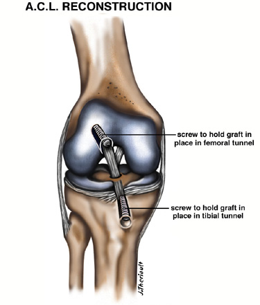 Diagram of ACL Reconstruction