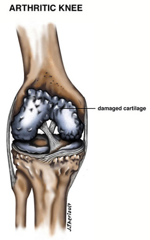 Diagram of an Arthritic Knee
