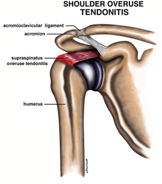 Diagram of Shoulder Tendonitis Caused by Overuse 