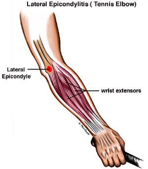 Diagram of Tennis Elbow, also known as Lateral Epicondylitis