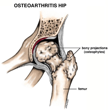 Diagram of an Osteoarthritis Hip Showing Osteophytes