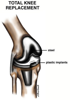 Diagram of a Total Knee Replacement Showing Steel and Plastic Implants