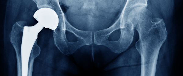 Total Hip Replacement Surgery  Orthopedic Associates of Hartford