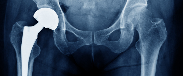 5 Signs You Need a Hip Replacement | Orthopedic Associates of Hartford